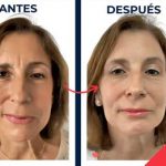 Tratamiento de la parálisis facial con botox en el Hospital Cruz Roja de Córdoba