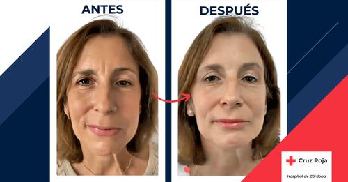 Tratamiento de la parálisis facial con botox en el Hospital Cruz Roja de Córdoba